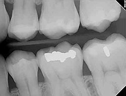 Digital X-Rays Prince Dental Group dentist in Midway, UT Dr. David Prince